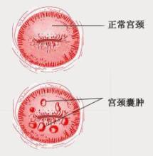 患了宫颈囊肿,要怎么治疗?
