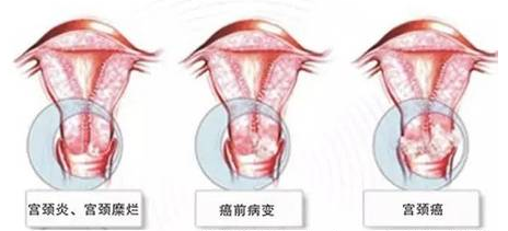 宫颈炎、快速治疗是关键!